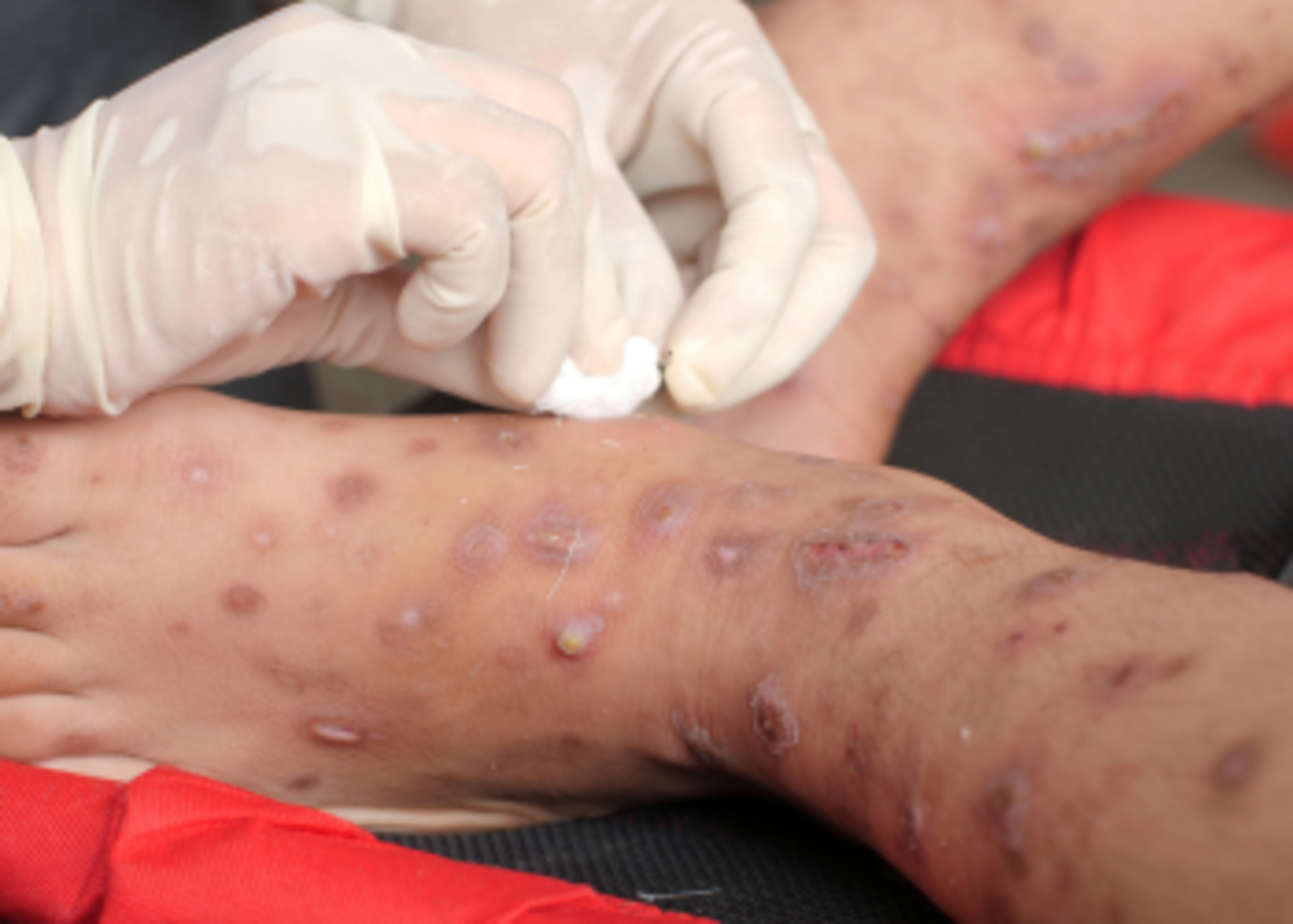 ⁠Skin infection treatment
